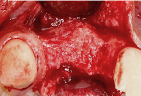 ridge of edentulous site