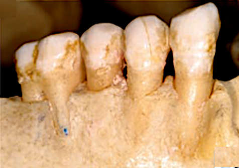 Tooth-dependent structure