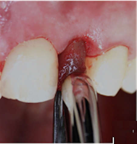 toward tooth extraction